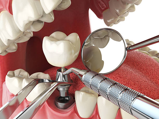 Best Dentist for Tooth Abscess  in New Castle, PA